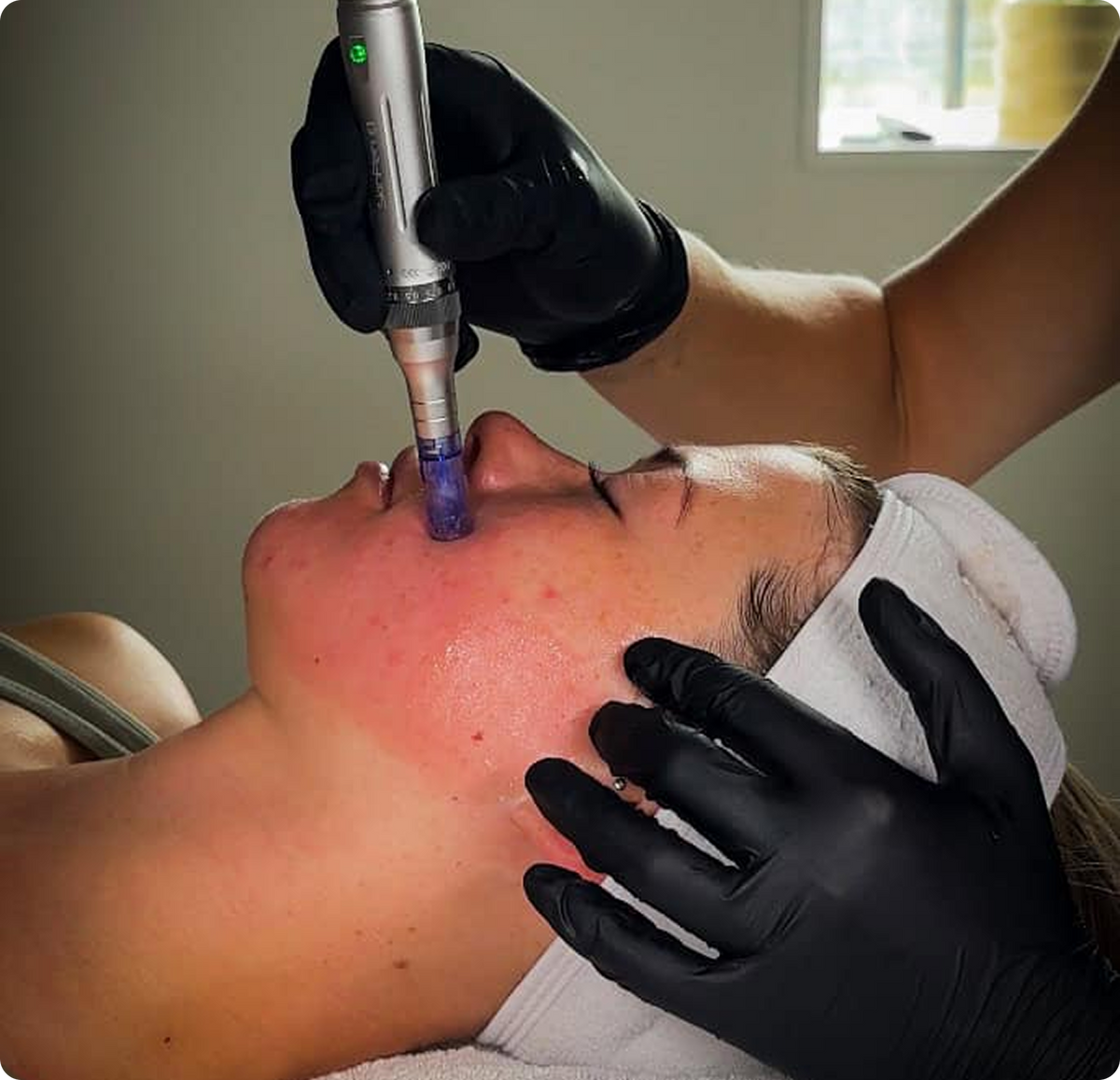Microneedling - SkinPen behandlinger