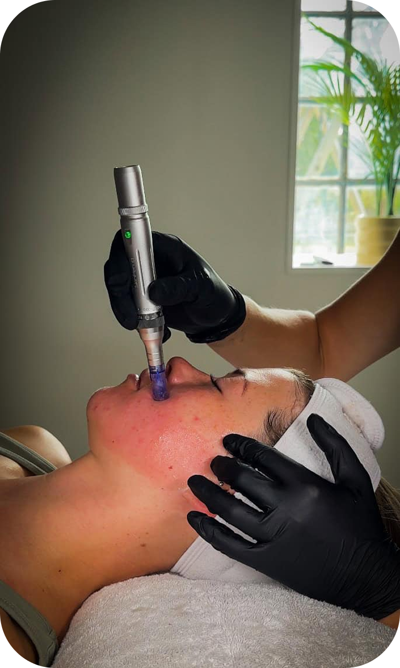 Microneedling